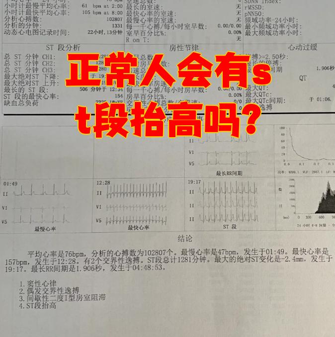 st多少正常(st1正常值)